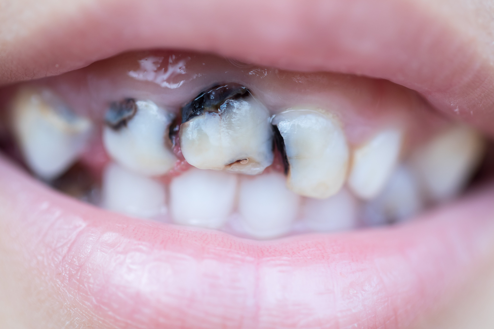歯 と 歯 の 間 黒い 虫歯