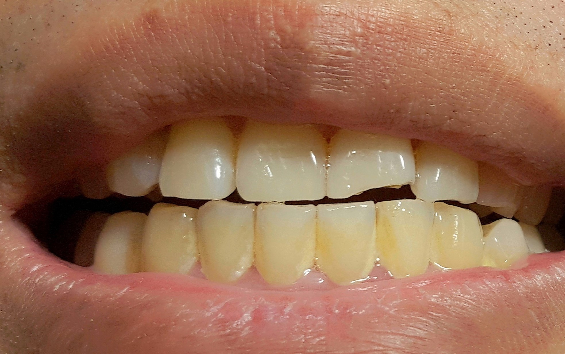歯 の 表面 ザラザラ