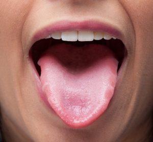 舌 の 真ん中 に でき もの