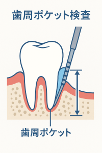 歯周ポケット測定の図