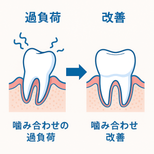 噛み合わせ過負荷 → 改善の2コマ図