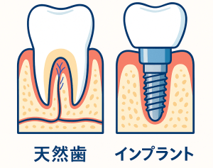 天然歯 vs インプラント断面図