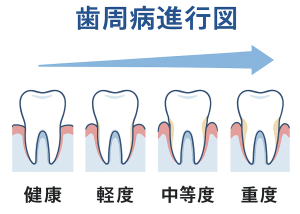 歯周病の進行（健康→軽度→中等度→重度）